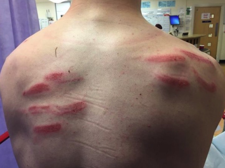 恐怖！英非联门将为扑救留下9道伤疤