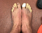 如何解冻脚趾？拉拉纳展示脚伤照片