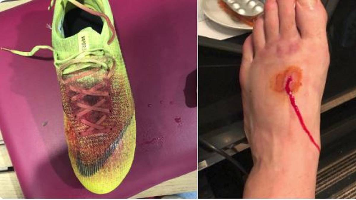 惨不忍睹，卢卡斯-佩雷斯比赛中被踩伤，鲜血染红球鞋