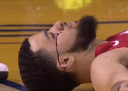 [视频]利文斯顿肘部打到范弗利特，后者眼角流血并掉牙