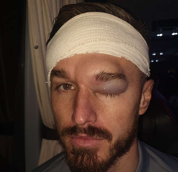 惨啊!卡迪夫城后卫和队友相撞,眼部肿至馒头大小