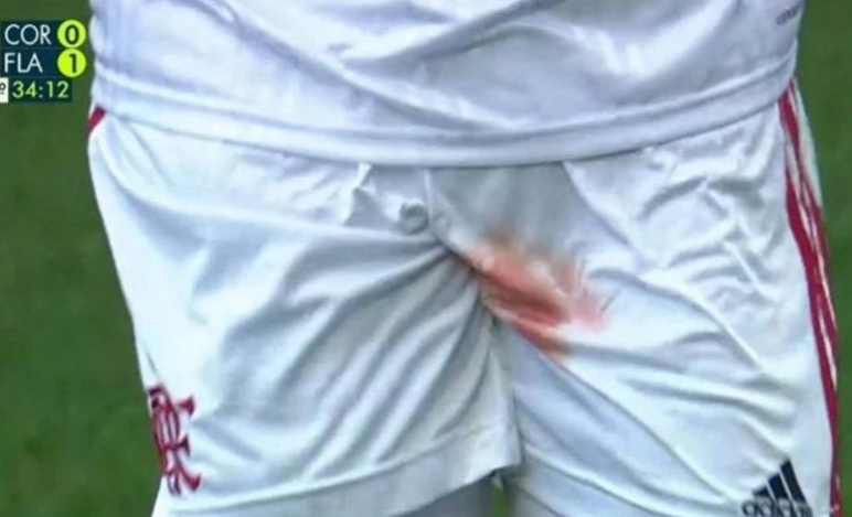 鸡飞蛋打，弗拉门戈一球员比赛中隐私部位受伤血染白短裤